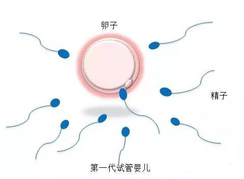 体外受精 IVF-ET
